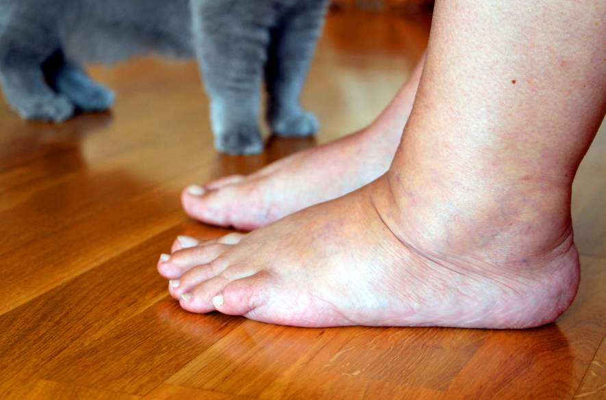 Diabetes e pés inchados: entenda a relação